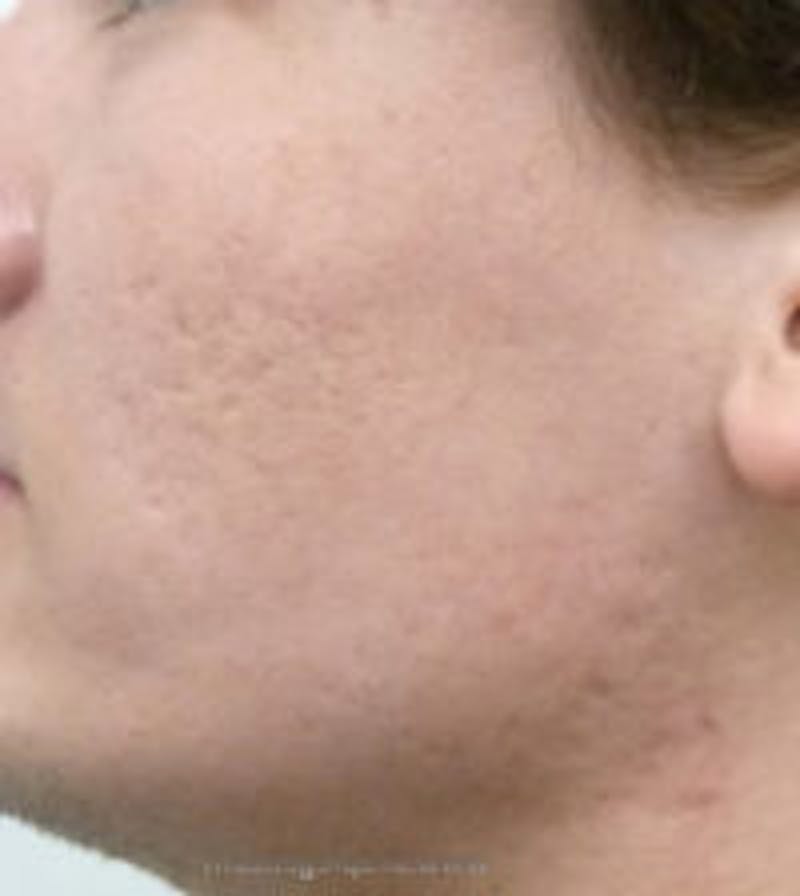 Microneedling Before & After Gallery - Patient 157140487 - Image 1