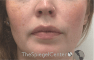 Nasolabial Fold Filler Before & After Gallery - Patient 157140489 - Image 2