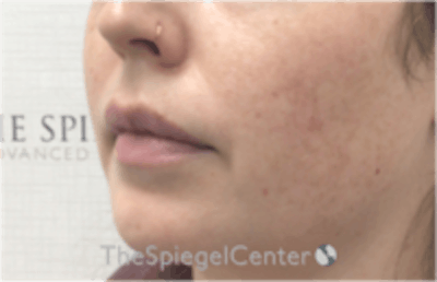 Nasolabial Fold Filler Before & After Gallery - Patient 157140489 - Image 3
