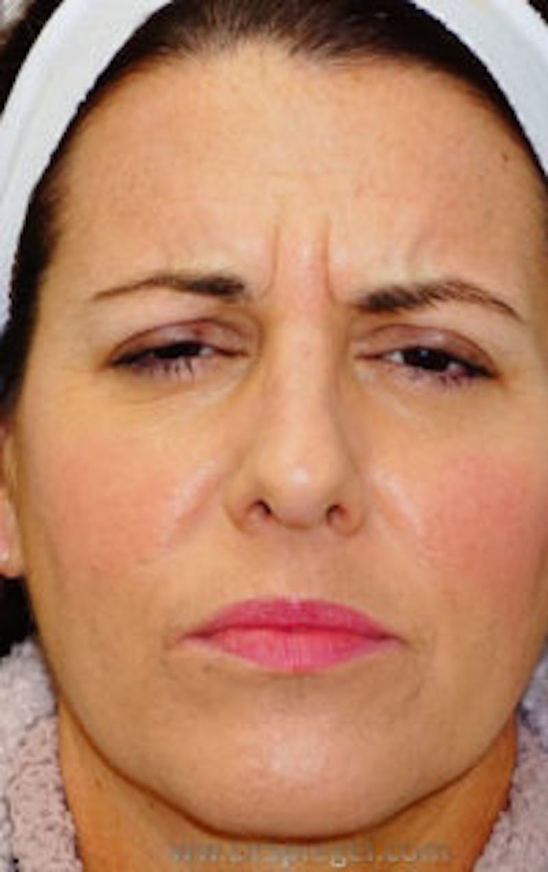 Botox / Dysport / Jeuveau / Xeomin Before & After Gallery - Patient 157140495 - Image 1