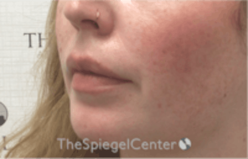 Nasolabial Fold Filler Before & After Gallery - Patient 157140489 - Image 4