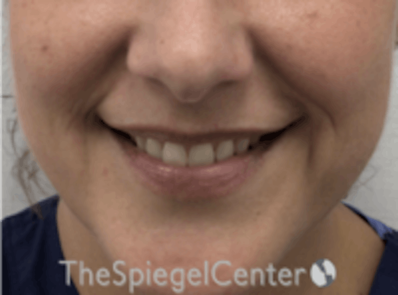 Lip Filler Before & After Gallery - Patient 157140501 - Image 1