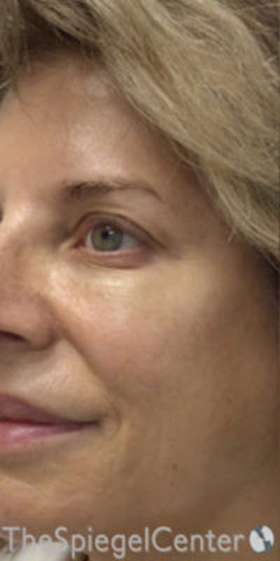 Morpheus8 Before & After Gallery - Patient 157140490 - Image 2