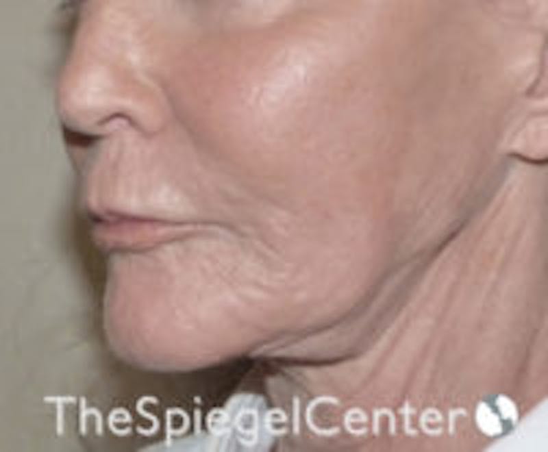 Neck Line Botox Before & After Gallery - Patient 157140493 - Image 1