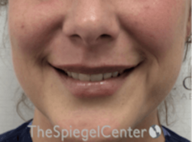 Lip Filler Before & After Gallery - Patient 157140501 - Image 2