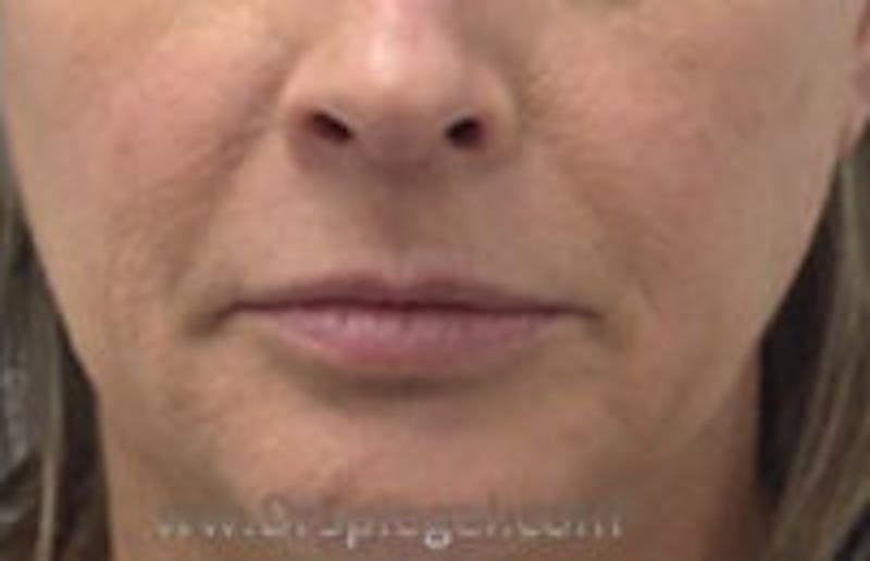 Nasolabial Fold Filler Before & After Gallery - Patient 157140497 - Image 1