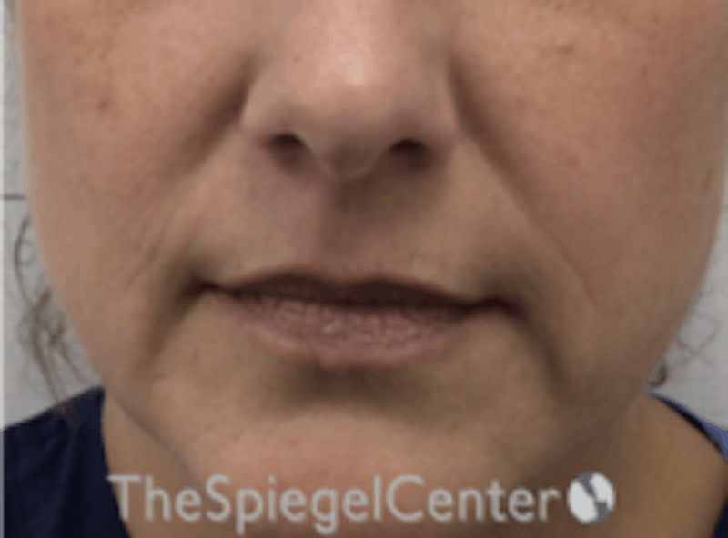 Lip Filler Before & After Gallery - Patient 157140501 - Image 3