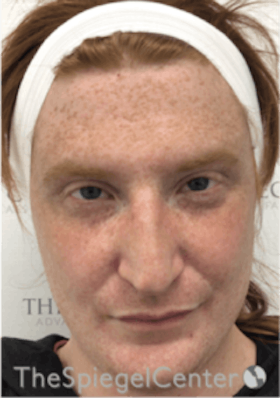 FFS Before & After Gallery - Patient 157140503 - Image 1