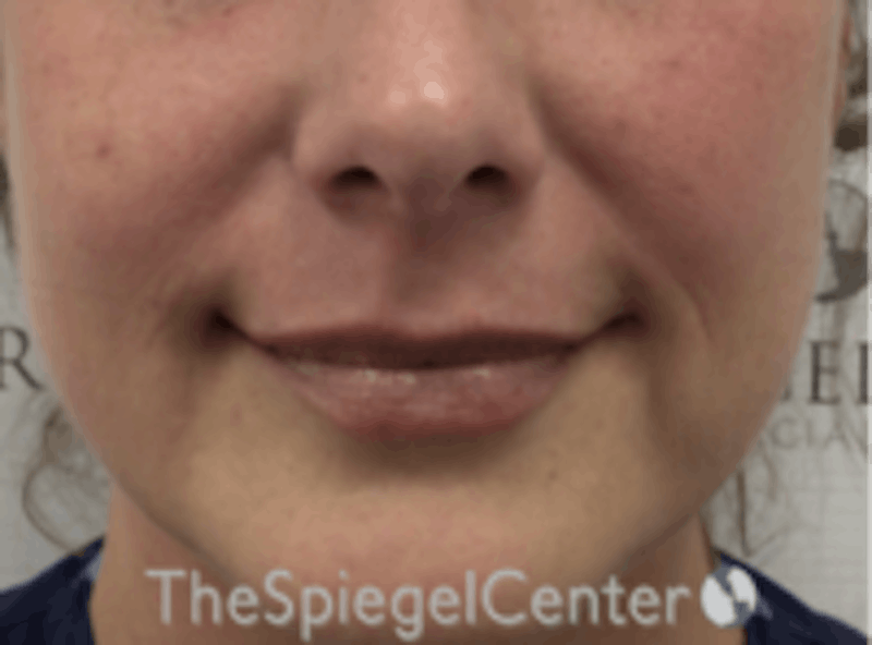 Lip Filler Before & After Gallery - Patient 157140501 - Image 4