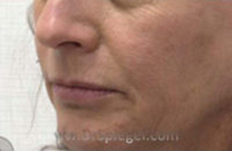 Nasolabial Fold Filler Before & After Gallery - Patient 157140497 - Image 3