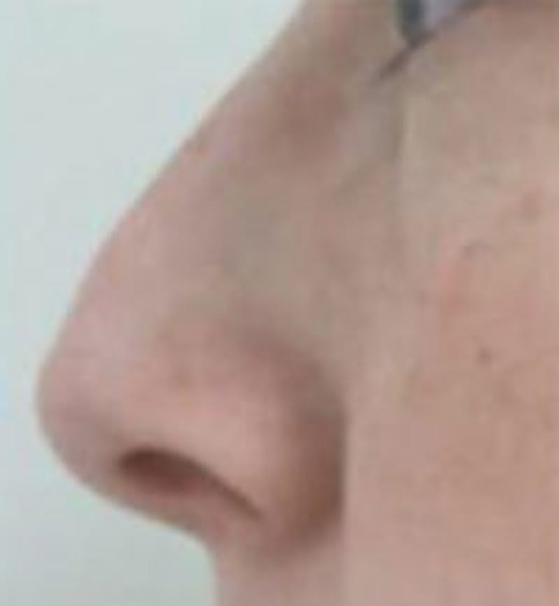Rhinoplasty Before & After Gallery - Patient 157140499 - Image 1