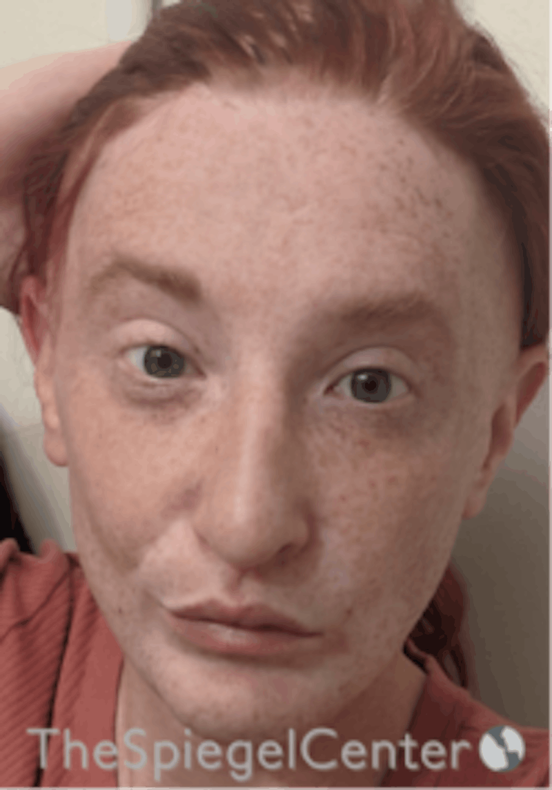 FFS Before & After Gallery - Patient 157140503 - Image 2