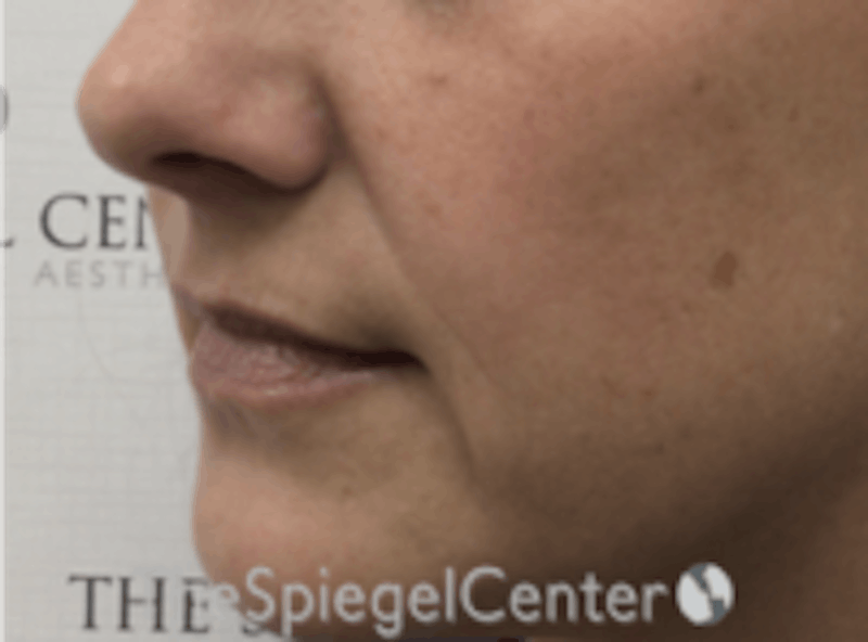 Lip Filler Before & After Gallery - Patient 157140501 - Image 5
