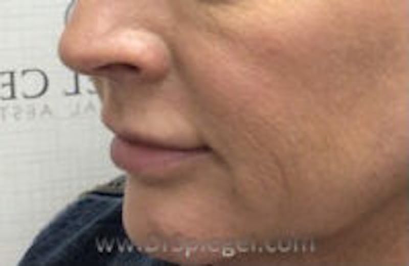 Nasolabial Fold Filler Before & After Gallery - Patient 157140497 - Image 4