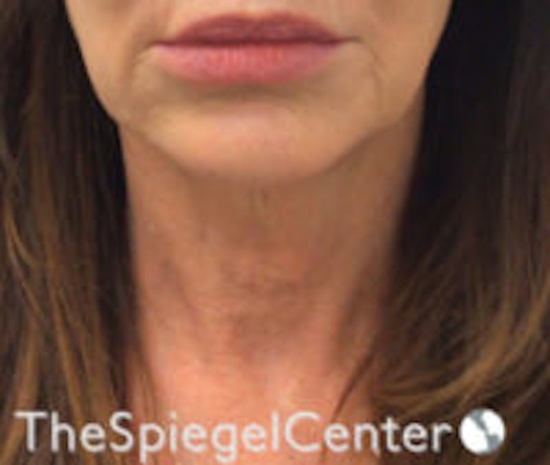 Neck Line Botox Before & After Gallery - Patient 157140500 - Image 2