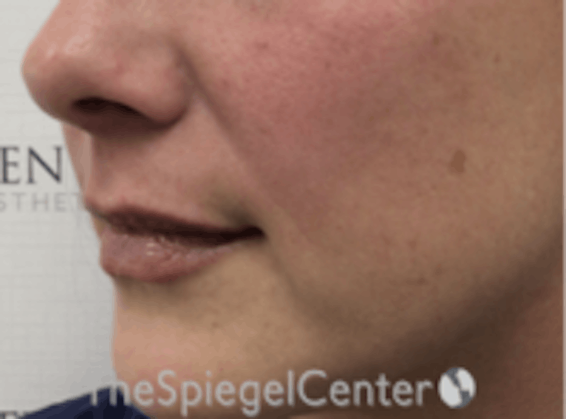Lip Filler Before & After Gallery - Patient 157140501 - Image 6