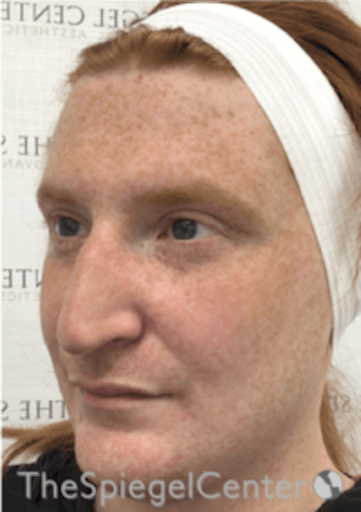 FFS Before & After Gallery - Patient 157140503 - Image 3