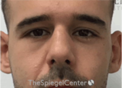 Non-Surgical Rhinoplasty / Nose Filler Before & After Gallery - Patient 157140507 - Image 1