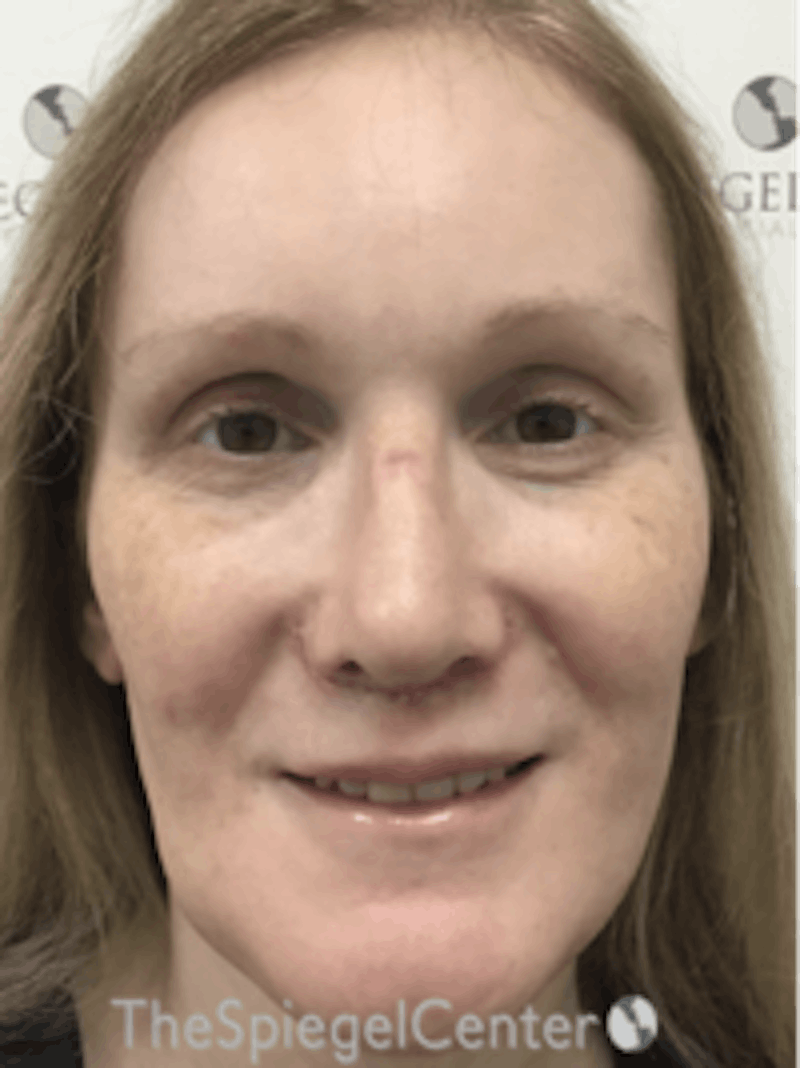 Morpheus8 Before & After Gallery - Patient 157140508 - Image 1