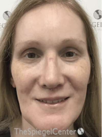 Morpheus8 Before & After Gallery - Patient 157140508 - Image 1