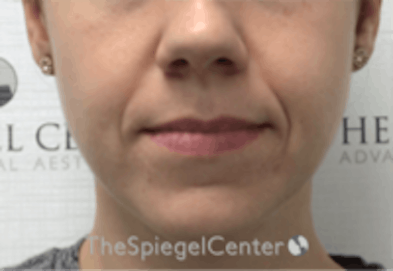 Nasolabial Fold Filler Before & After Gallery - Patient 157140510 - Image 1