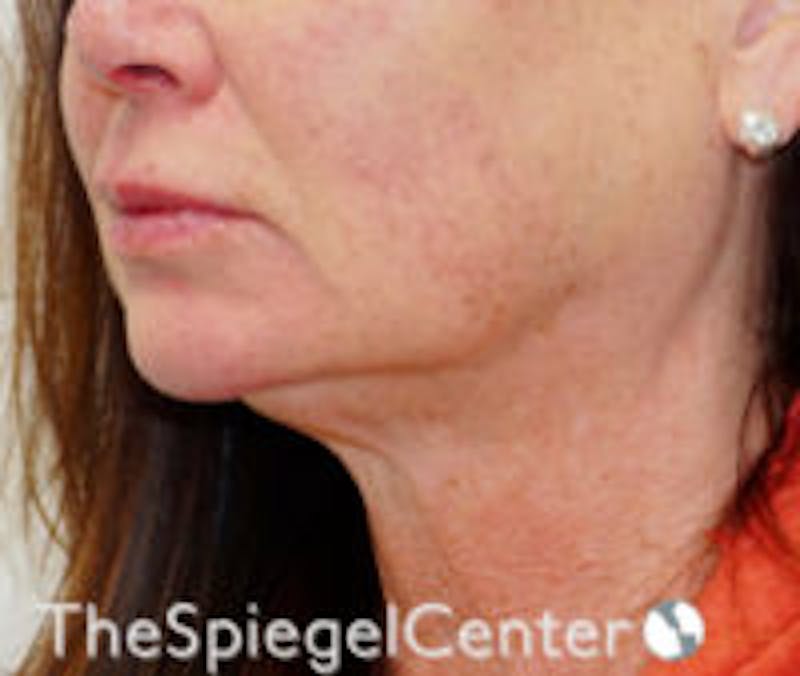 Neck Line Botox Before & After Gallery - Patient 157140506 - Image 1