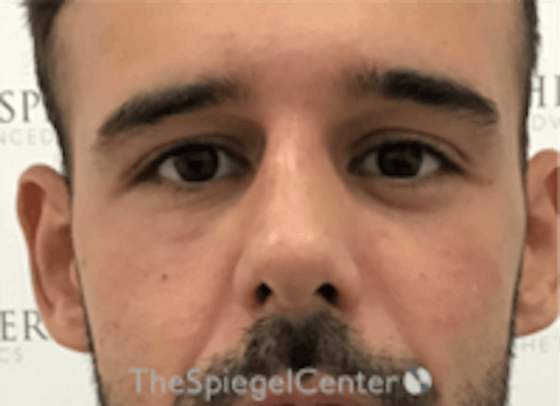 Non-Surgical Rhinoplasty / Nose Filler Before & After Gallery - Patient 157140507 - Image 2