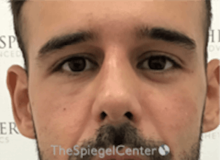 Non-Surgical Rhinoplasty / Nose Filler Before & After Gallery - Patient 157140507 - Image 2