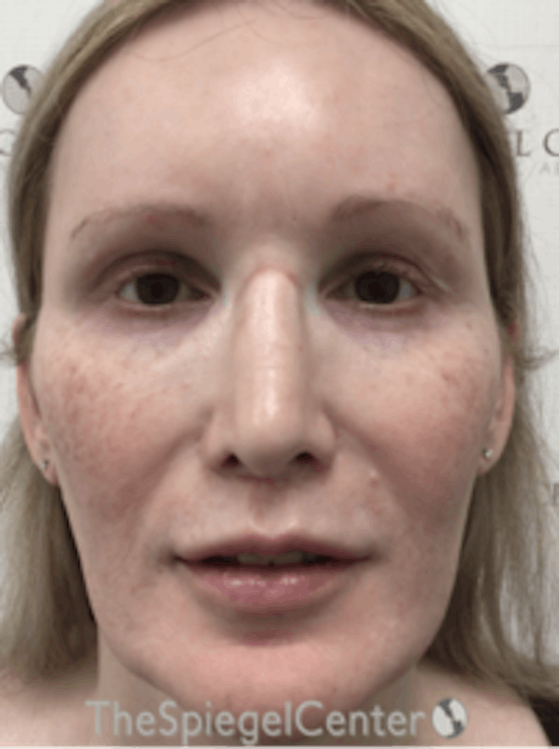 Morpheus8 Before & After Gallery - Patient 157140508 - Image 2