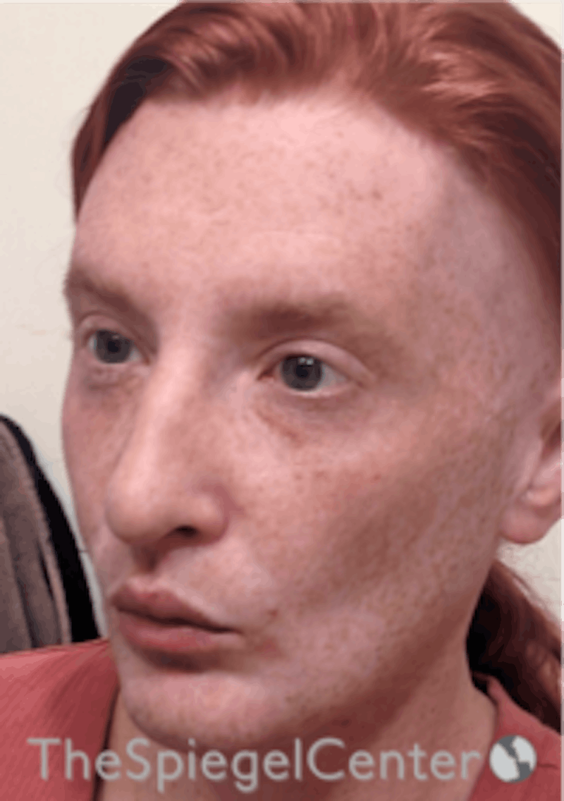 FFS Before & After Gallery - Patient 157140503 - Image 4