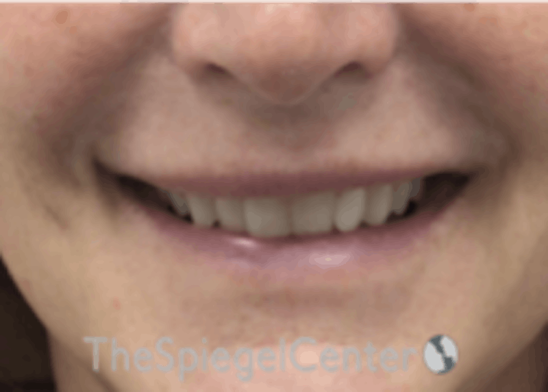 Lip Filler Before & After Gallery - Patient 157140516 - Image 1