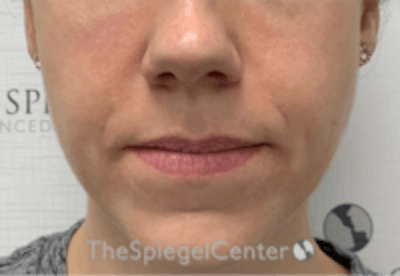 Nasolabial Fold Filler Before & After Gallery - Patient 157140510 - Image 2