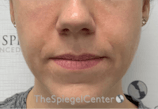 Nasolabial Fold Filler Before & After Gallery - Patient 157140510 - Image 2