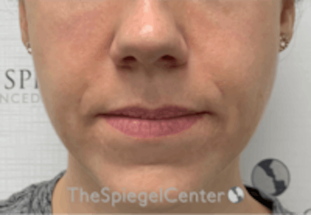 Nasolabial Fold Filler