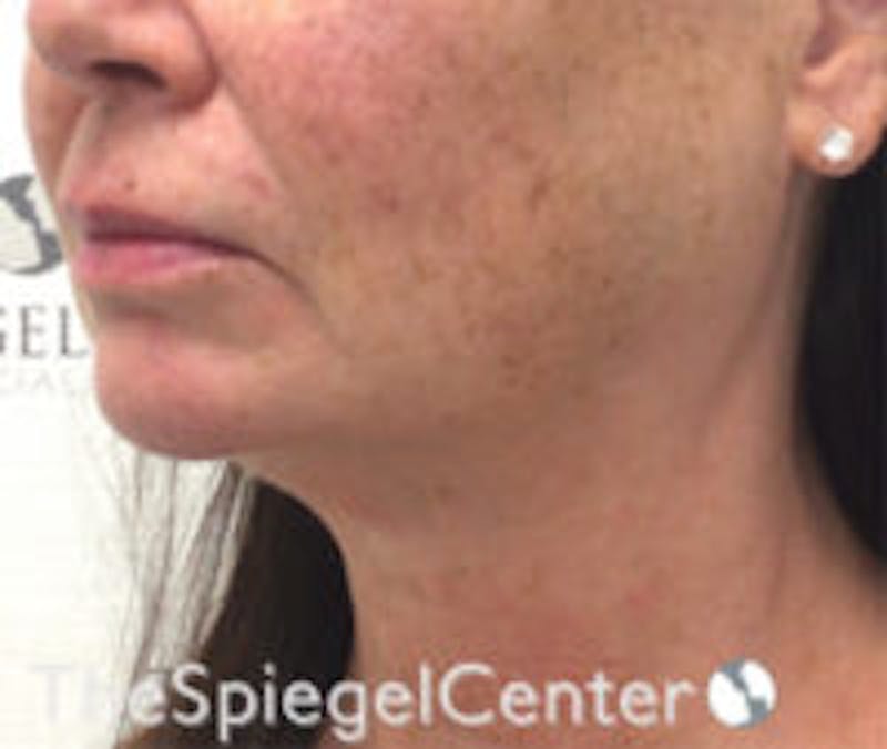 Neck Line Botox Before & After Gallery - Patient 157140506 - Image 2