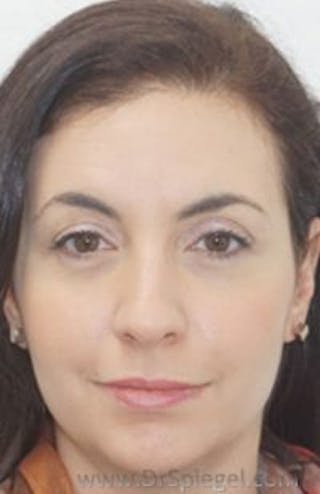 Botox / Dysport / Jeuveau / Xeomin Before & After Gallery - Patient 157140505 - Image 4