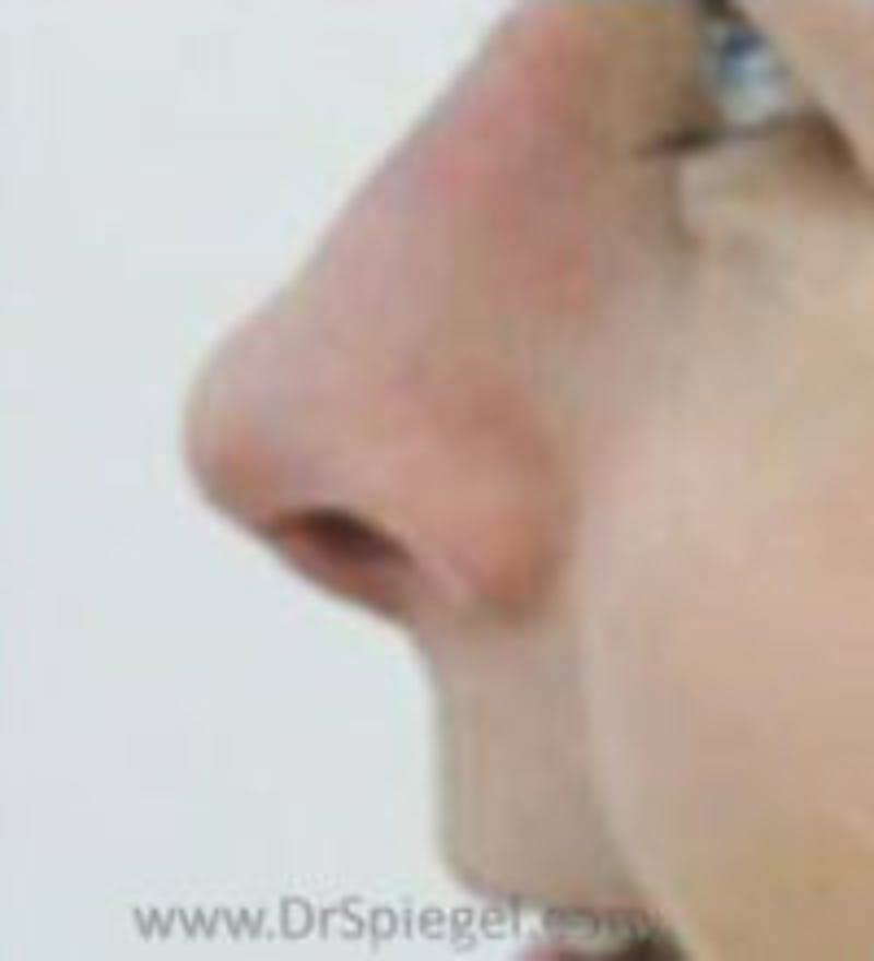 Rhinoplasty Before & After Gallery - Patient 157140504 - Image 2