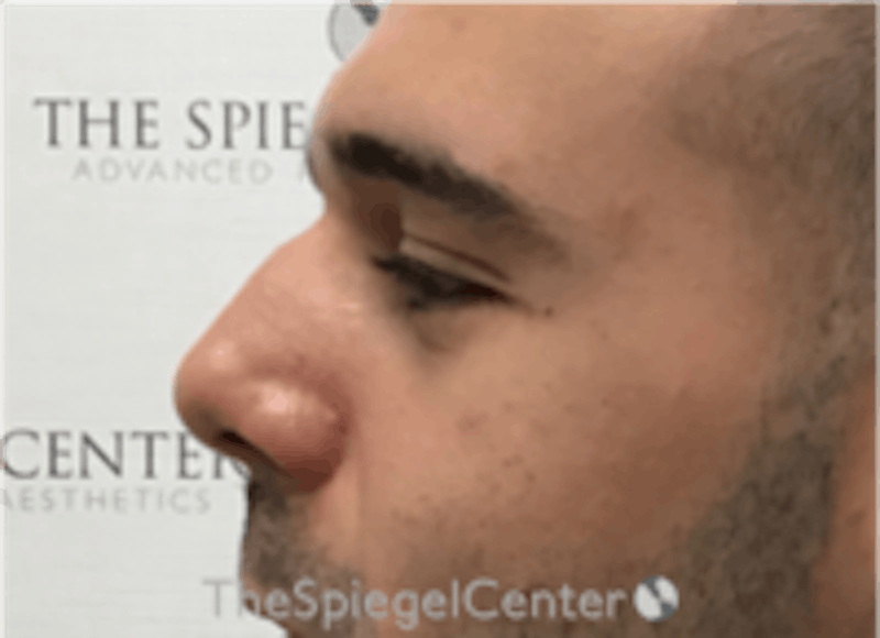 Non-Surgical Rhinoplasty / Nose Filler Before & After Gallery - Patient 157140507 - Image 3