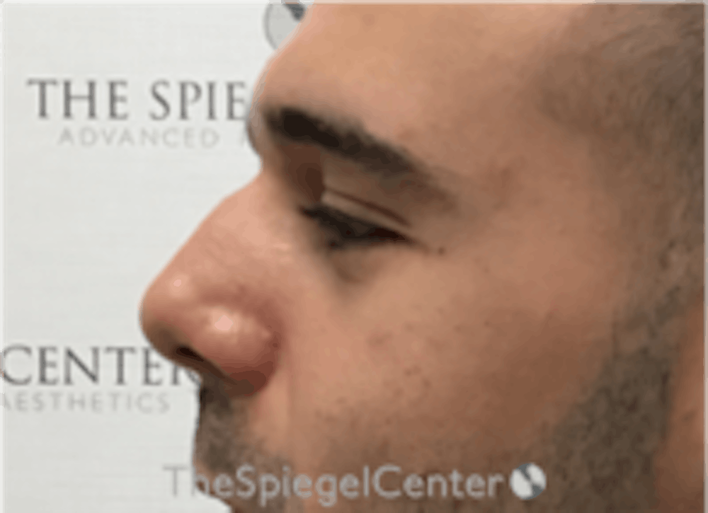 Non-Surgical Rhinoplasty