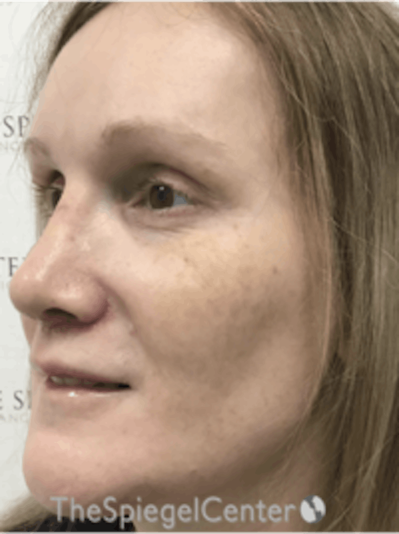 Morpheus8 Before & After Gallery - Patient 157140508 - Image 3