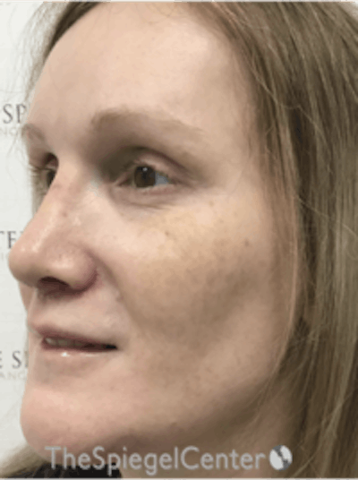 Morpheus8 Before & After Gallery - Patient 157140508 - Image 3