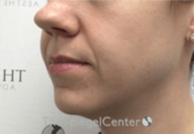 Nasolabial Fold Filler Before & After Gallery - Patient 157140510 - Image 3