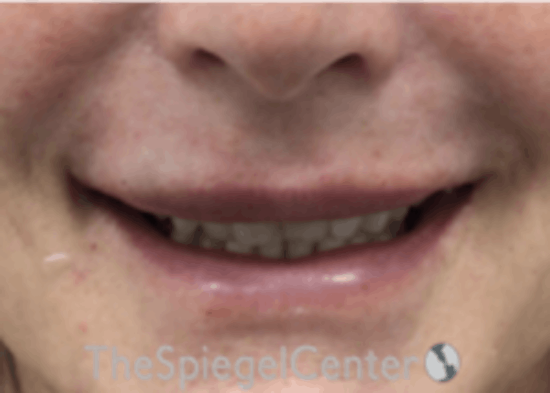 Lip Filler Before & After Gallery - Patient 157140516 - Image 2