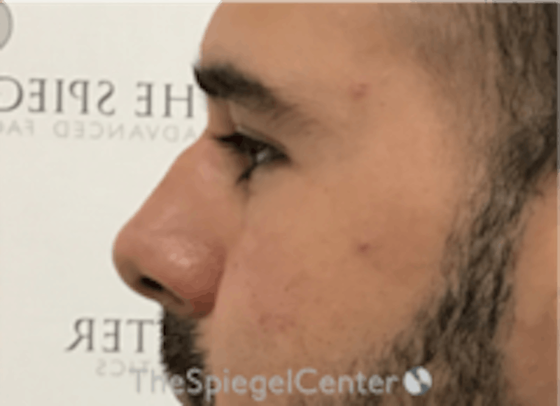 Non-Surgical Rhinoplasty / Nose Filler Before & After Gallery - Patient 157140507 - Image 4