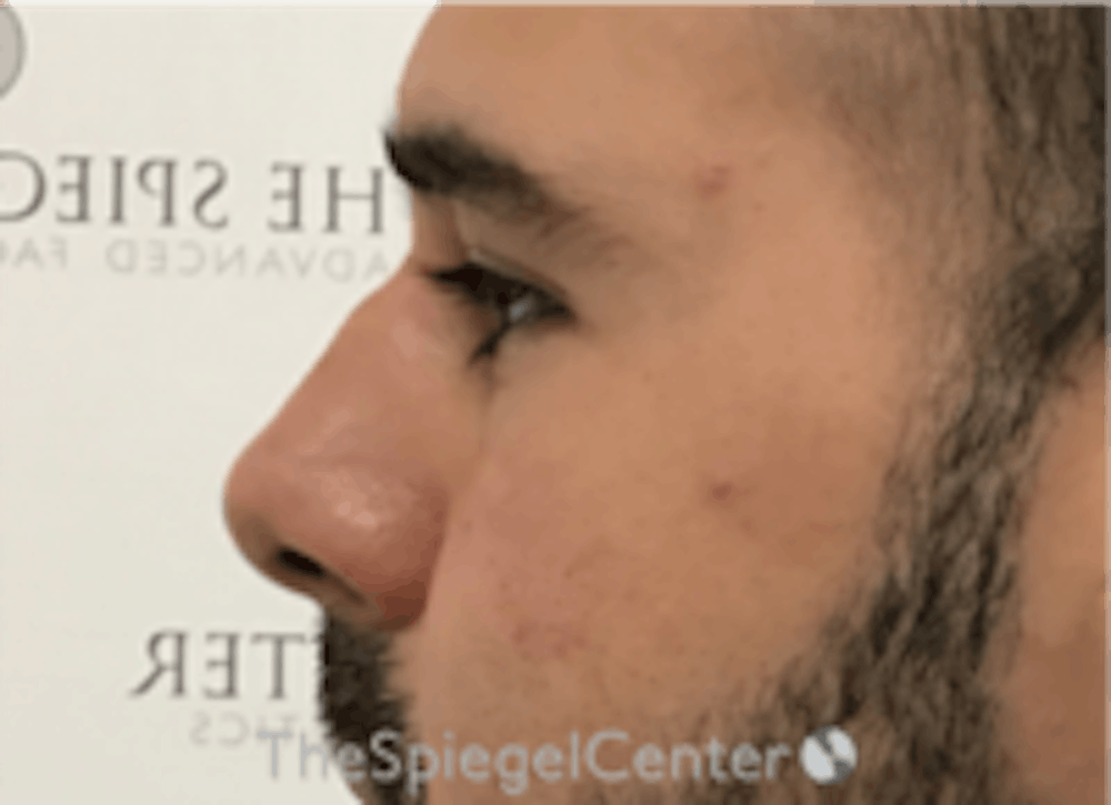 Non-Surgical Rhinoplasty