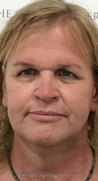 FFS Before & After Gallery - Patient 157140515 - Image 1