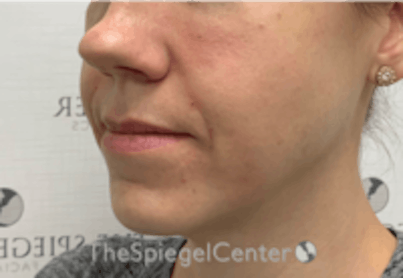 Nasolabial Fold Filler Before & After Gallery - Patient 157140510 - Image 4