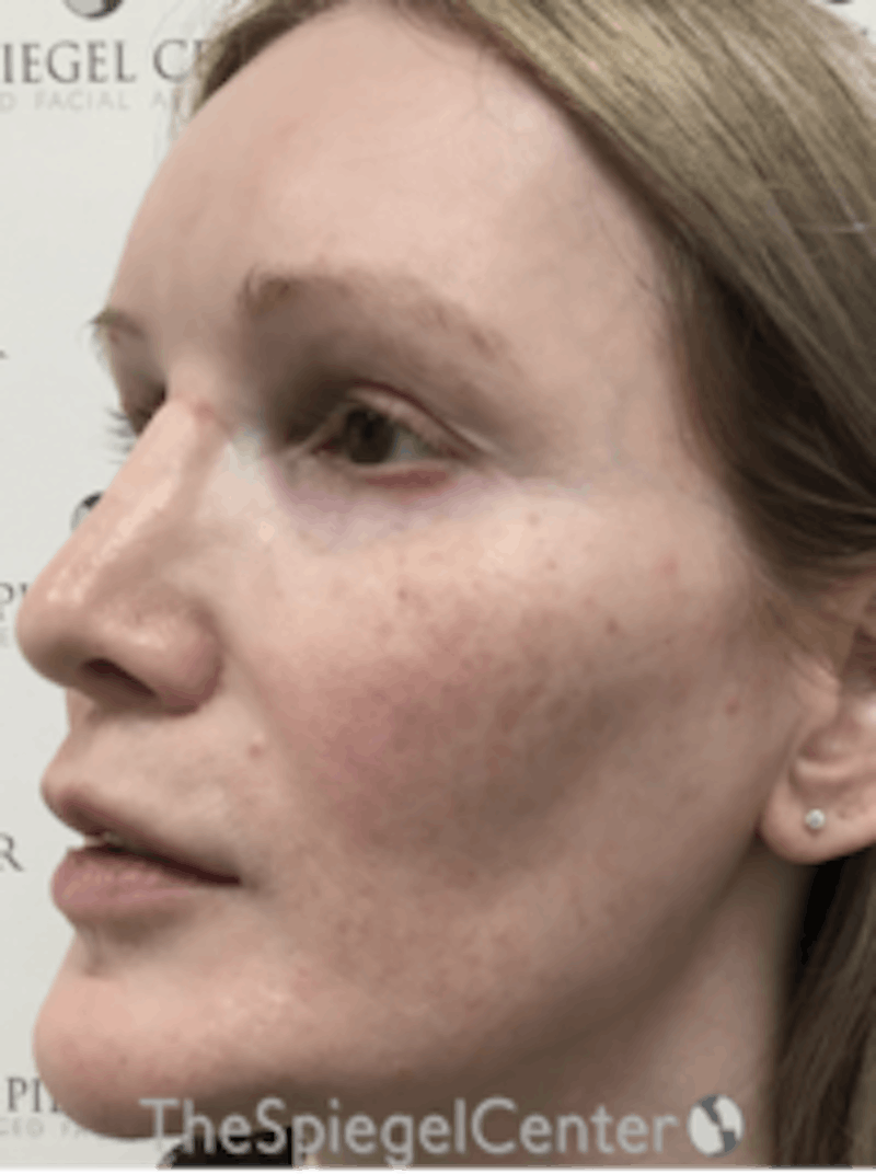 Morpheus8 Before & After Gallery - Patient 157140508 - Image 4