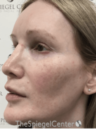 Morpheus8 Before & After Gallery - Patient 157140508 - Image 4