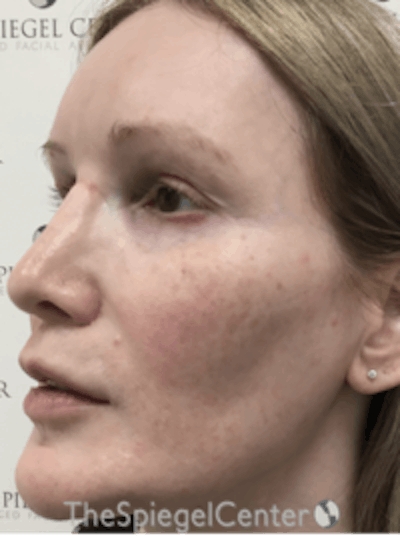 Morpheus8 Before & After Gallery - Patient 157140508 - Image 4
